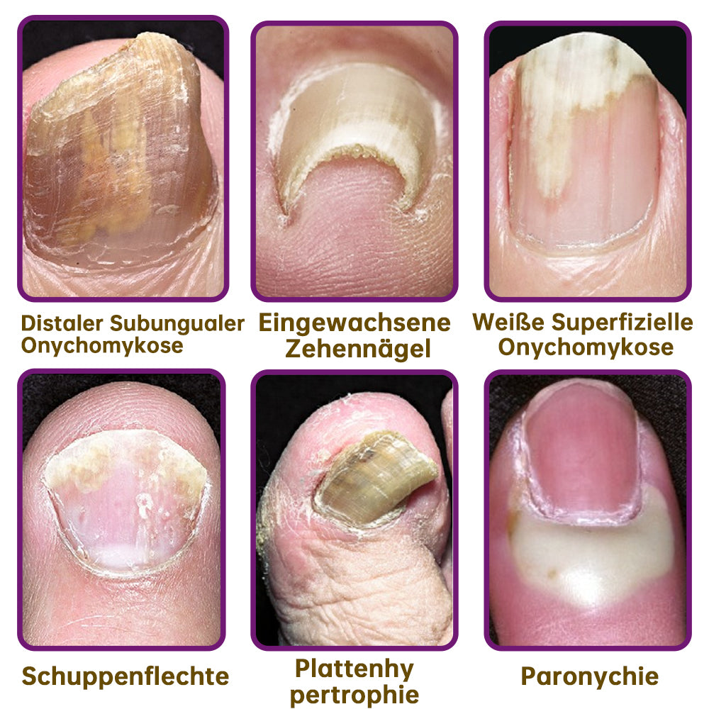 1+1 GRATIS | PilzSchutzschild™ Beseitigt Nagelpilz