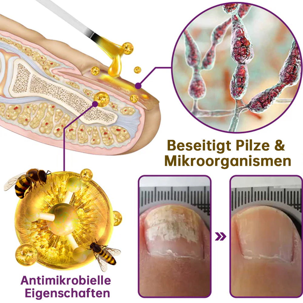 1+1 GRATIS | PilzSchutzschild™ Beseitigt Nagelpilz