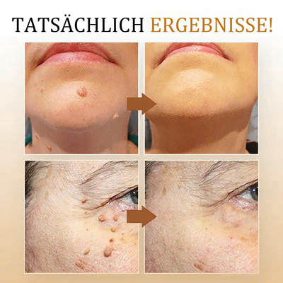 1+1 Gratis | Skin Free™ l Alle Flecken, Muttermale und Warzen werden innerhalb von 3 Tagen um 90% beseitigt!